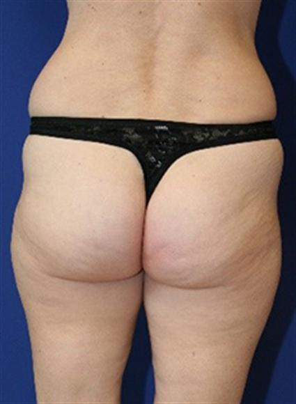 before buttock augmentation with fat graft