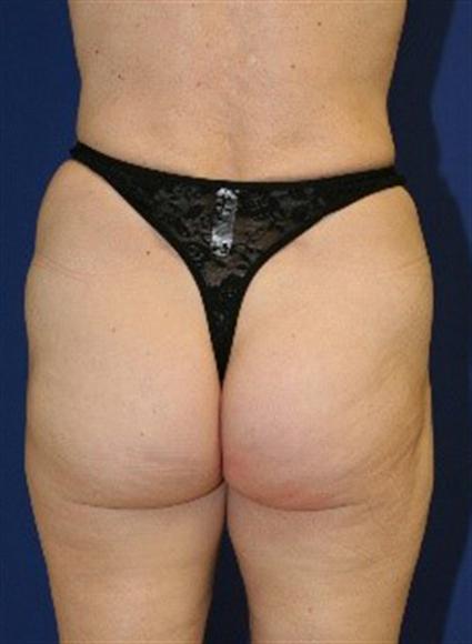 BUTTOCK AUGMENTATION WITH FAT GRAFTS 208
