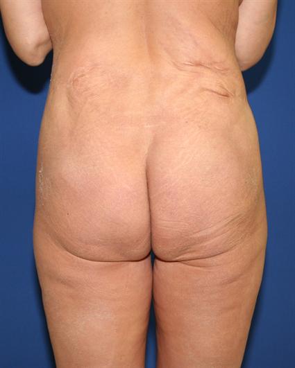 before buttock lift with augmentation