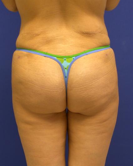 BUTTOCK LIFT WITH AUGMENTATION 210