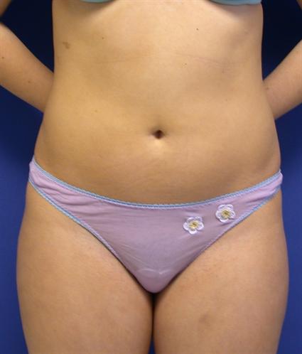 before female liposuction
