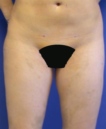 LIPOSUCTION 211