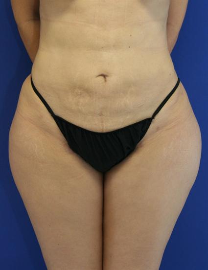 LIPOSUCTION 212
