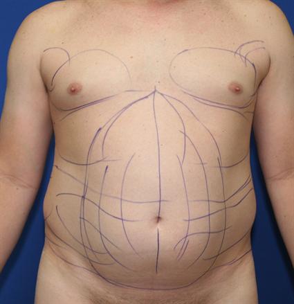 before male liposuction