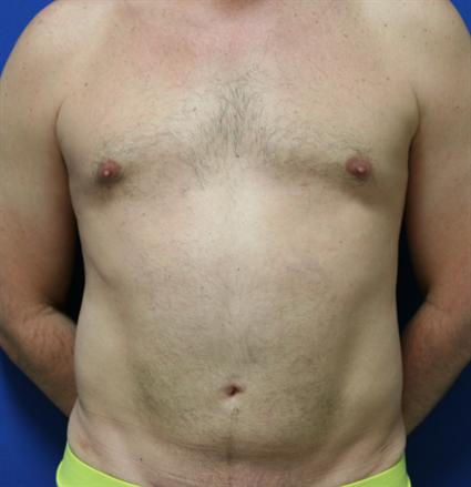 LIPOSUCTION 213