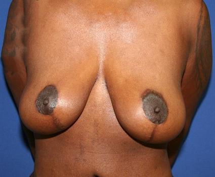 BREAST LIFT 216