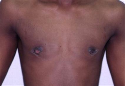 MALE BREAST SURGERY - GYNECOMASTIA 223