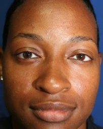 before ethnic nose surgery