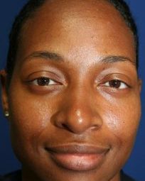 ETHNIC CORRECTIVE NOSE SURGERY 240