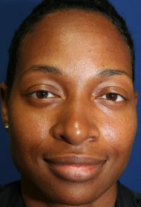 ETHNIC CORRECTIVE NOSE SURGERY 240