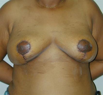 BREAST REDUCTION 245