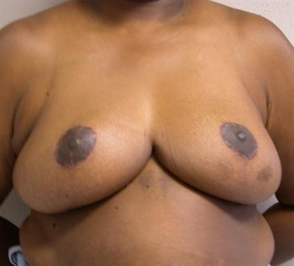 BREAST RECONSTRUCTION 246