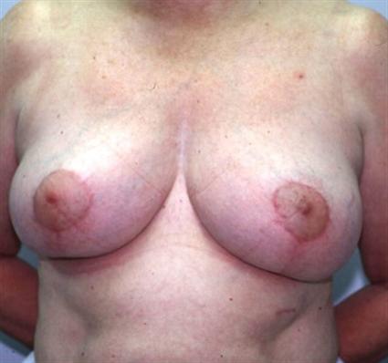 BREAST LIFT 247