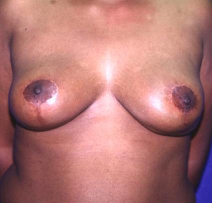 BREAST REDUCTION - POST OPERATIVE SCARS 248