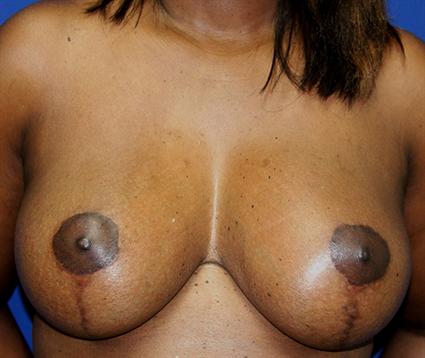 BREAST LIFT CASE 251