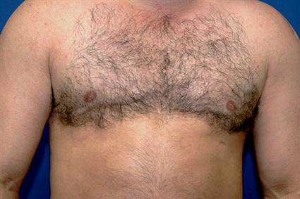 BREAST FAT GRAFTS CASE 252