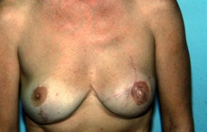 BREAST RECONSTRUCTION WITH BUTTOCK-THIGH FLAP 257