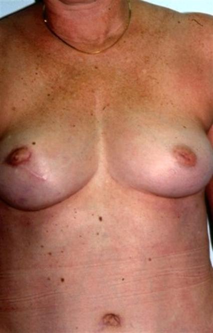 BREAST RECONSTRUCTION WITH FLAP AND FAT GRAFTS 260