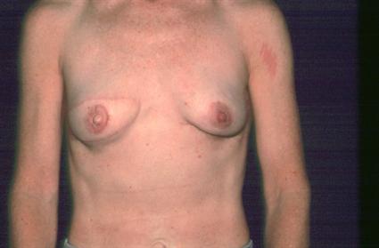 BREAST RECONSTRUCTION WITH BUTTOCK FLAP 261
