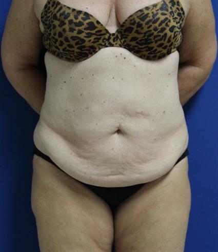 before female tummy tuck