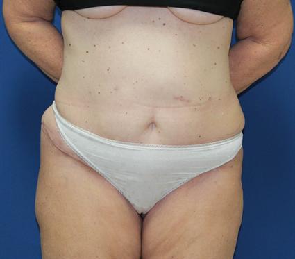 TUMMY TUCK - ABDOMINOPLASTY 301