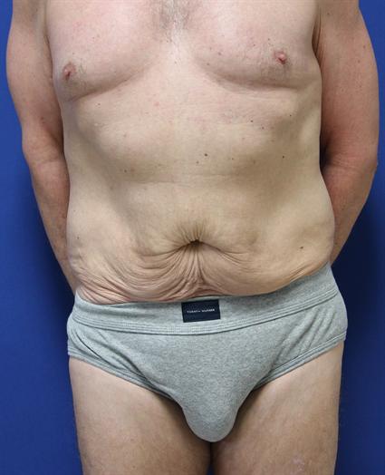 male tummy tuck before