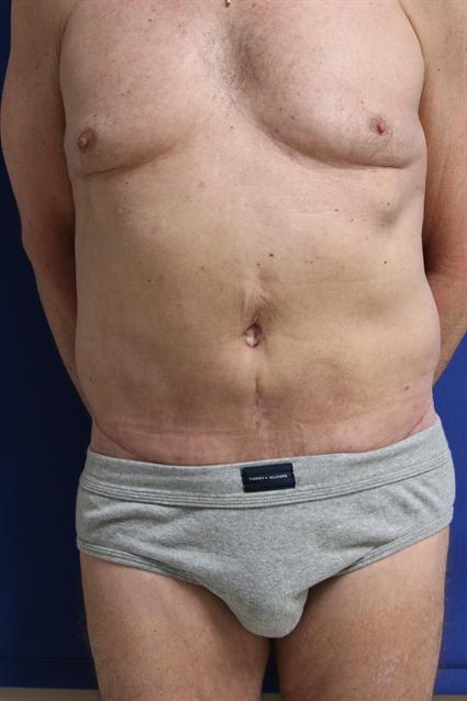TUMMY TUCK - ABDOMINOPLASTY 303