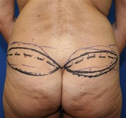 before buttock lift with fat graft