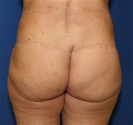 BUTTOCK LIFT W/ FAT GRAFTS 31