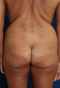 before buttock lift with fat graft