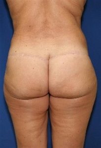 after buttock lift with fa graft