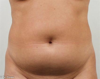 body contouring