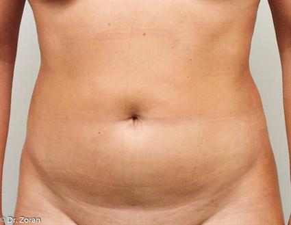 BODY CONTOURING SURGERY 32