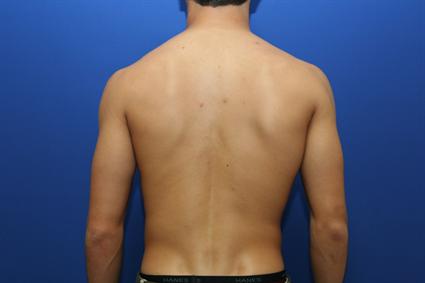 poland syndrome case 327 zoran potparic m d p a poland syndrome