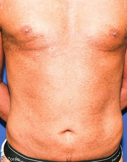 BODY CONTOURING - SUCTION LIPECTOMY 33