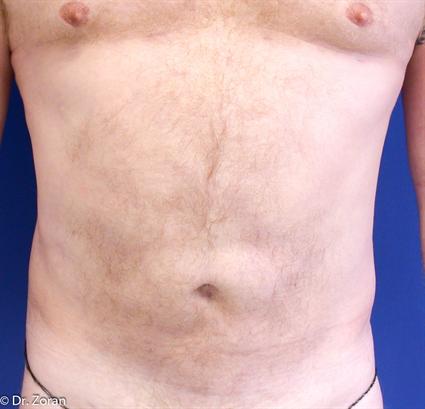 BODY CONTOURING - LIPOSUCTION 34