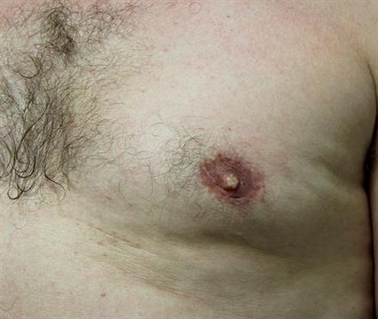 MALE BREAST SURGERY - GYNECOMASTIA CASE 344
