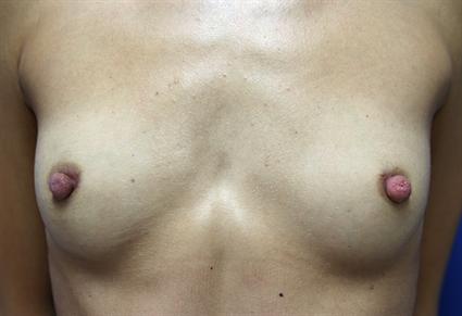 NIPPLE/AREOLA SURGERY CASE 345