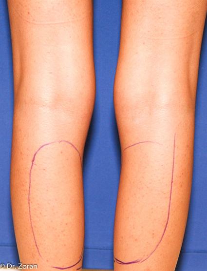 before female calf implants