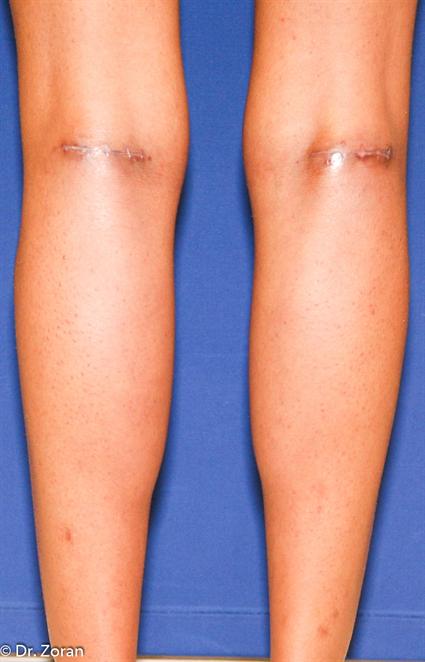 CALF IMPLANTS 35