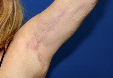 ARM LIFT CASE 353
