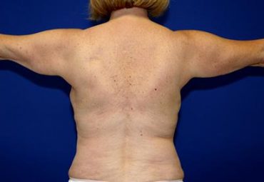 ARM LIFT CASE 354