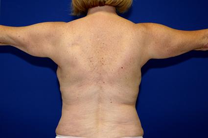 ARM LIFT CASE 354