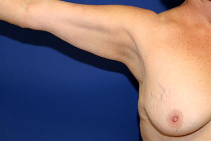 arm-lift