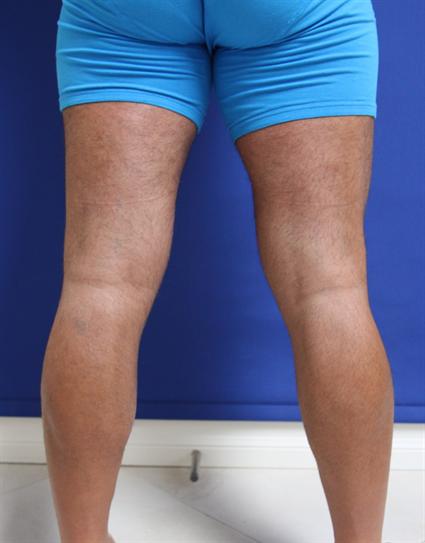 before male calf implants