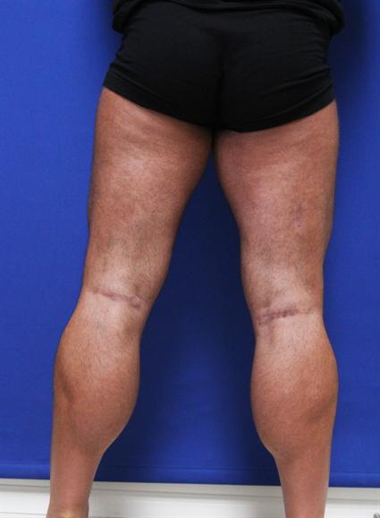 CALF IMPLANTS 366
