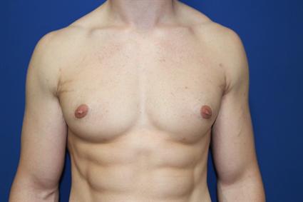 GYNECOMASTIA 369
