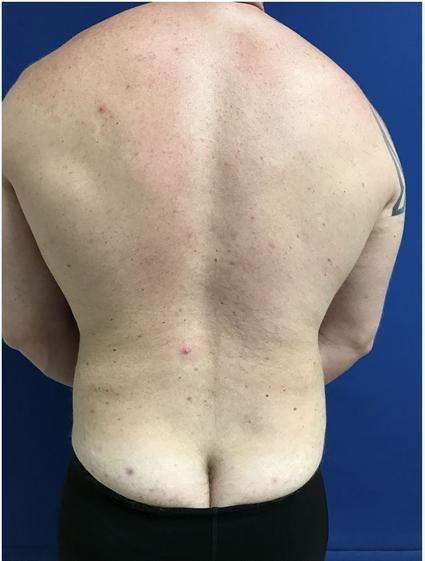 LIPOSUCTION CASE 380