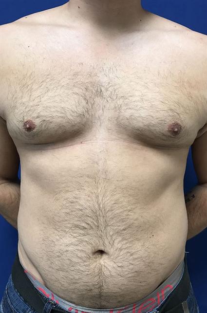 body contouring