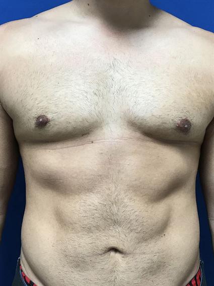 LIPOSUCTION 381